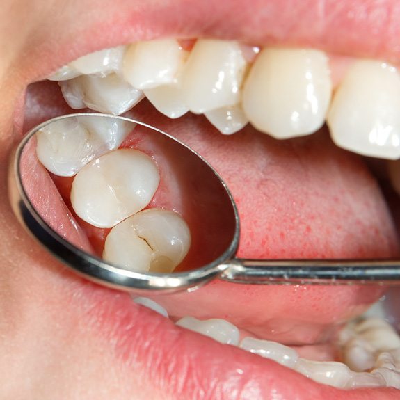 A close-up of a tooth-colored filling