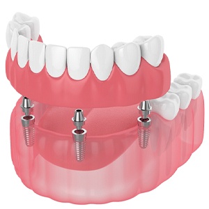 Implant dentures in Fort Worth