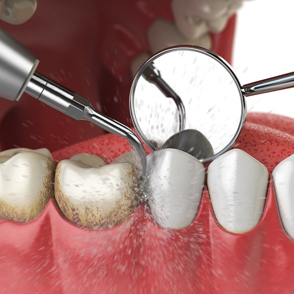 Animated smile during periodontal maintenance treatment