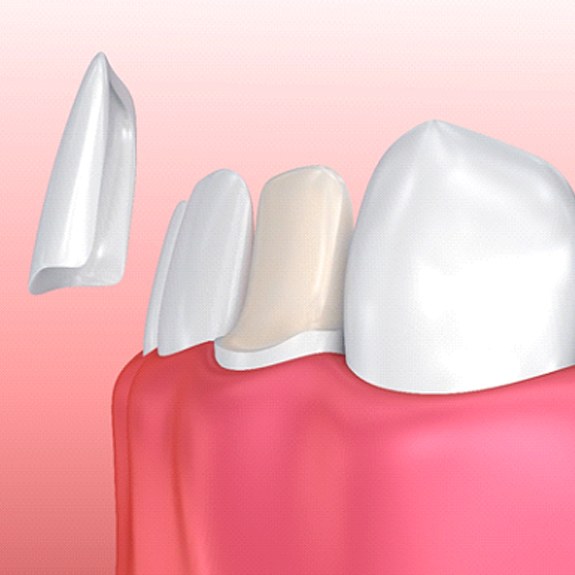 Diagram of veneers in Fort Worth