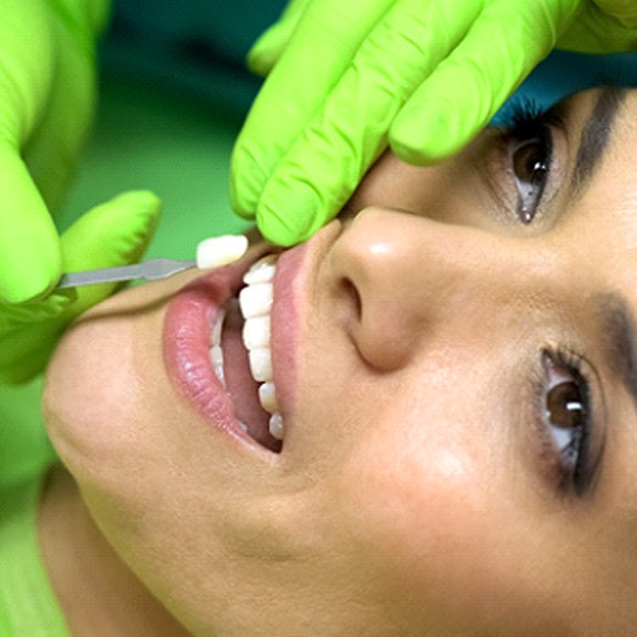 Closeup of woman getting veneers from her Forth Worth Dentist