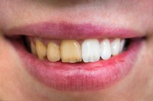 yellow teeth after whitening treatment