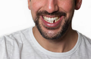 Man with a missing lower tooth