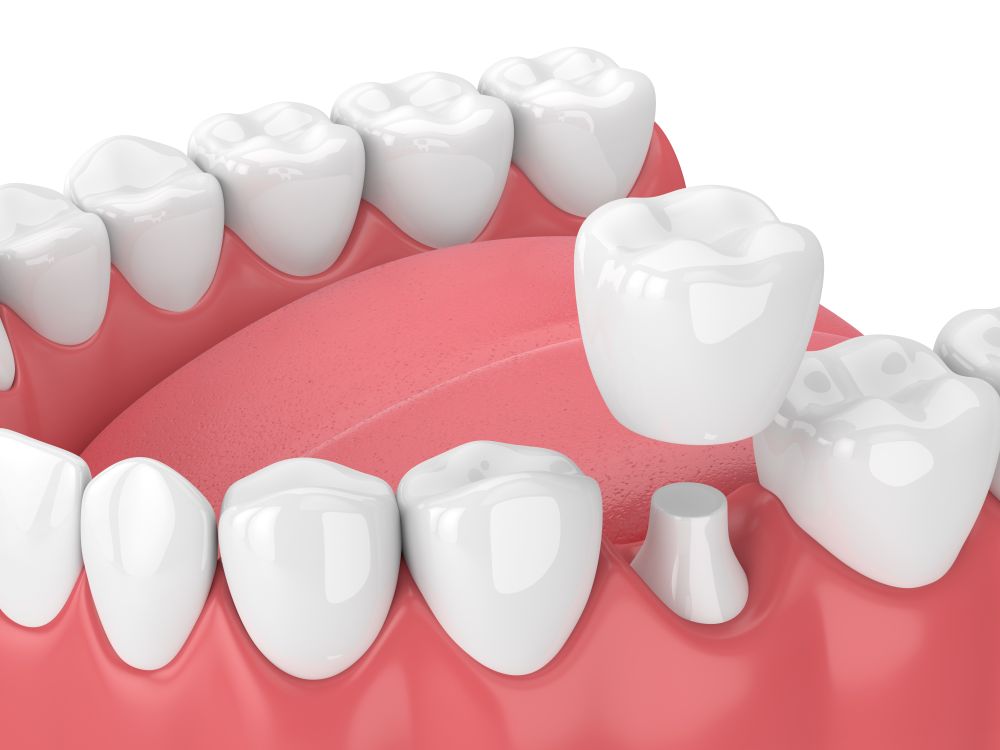 A computer-generated image of a dental crown and how it fits onto a prepared tooth